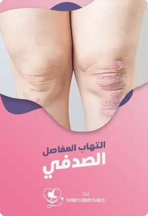 التهاب المفاصل الصدفي: الأعراض، الأسباب، وطرق العلاجfeatured image