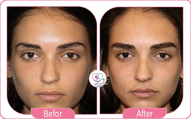 Eyebrow Transplant Timeline (Before and After)