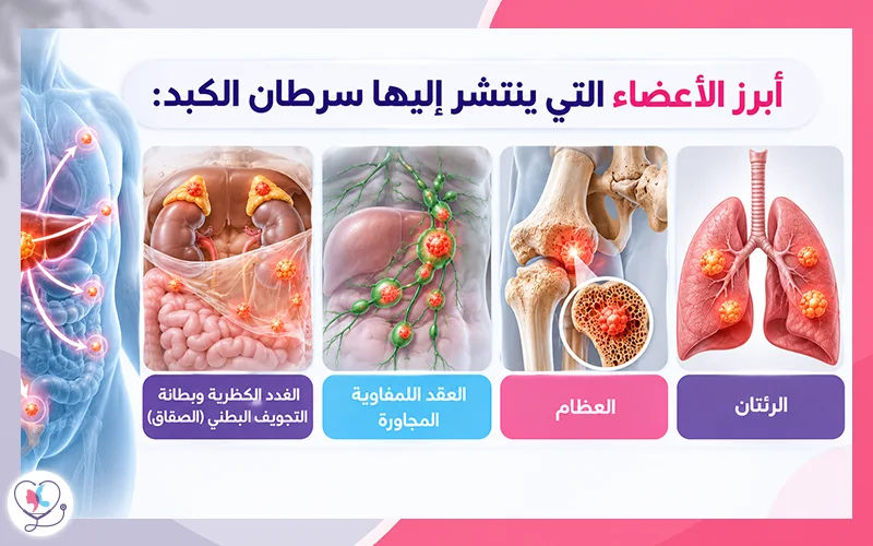 أبرز الأعضاء التي ينتشر إليها سرطان الكبد: