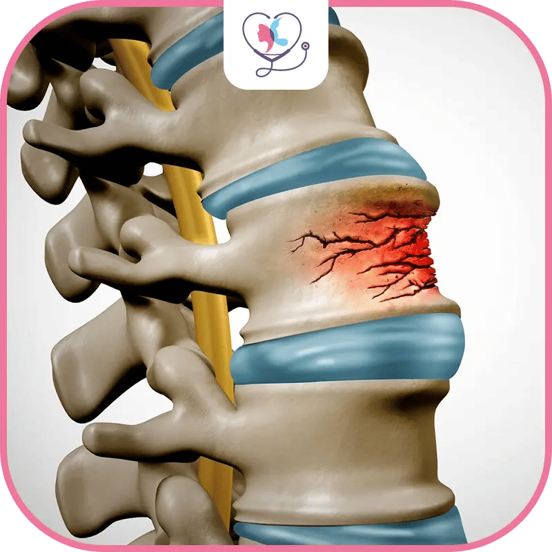 ماهي كسور الفقرات؟