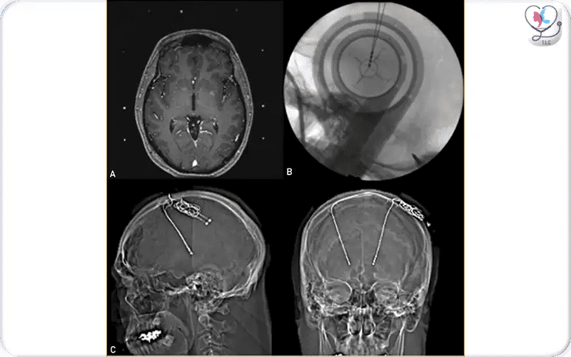 3. Lead Implantation (Awake vs Asleep) 4