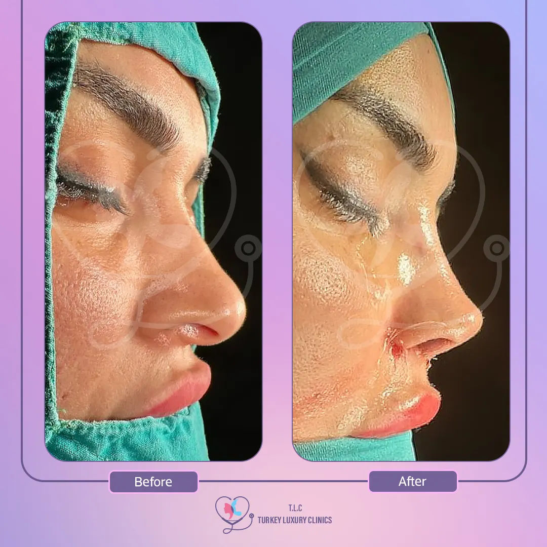 Faut-il opter pour une rhinoplastie chirurgicale ou non chirurgicale ?