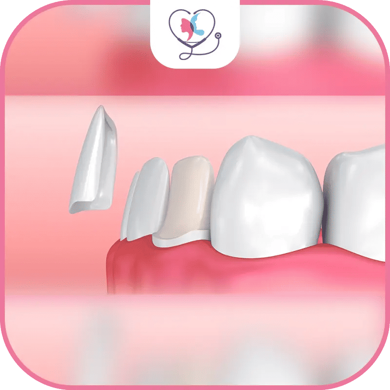 العوامل المؤثرة في تكلفة قشور الأسنان