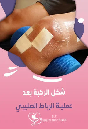 شكل الركبة بعد عملية الرباط الصليبي: صور قبل وبعد