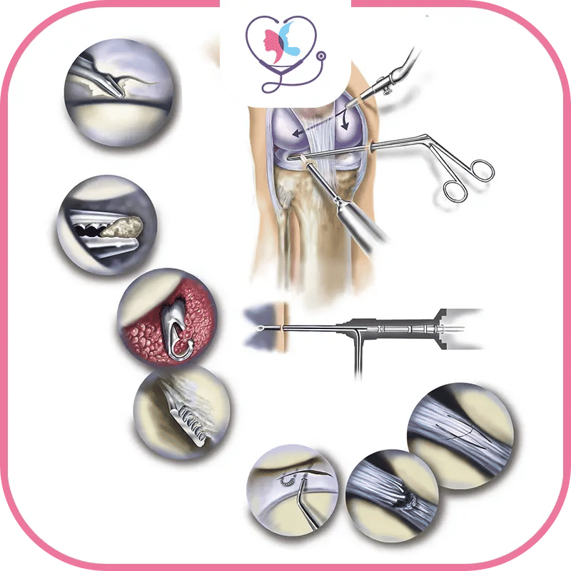 كيف يتمُّ علاج فشل عملية تغيير مفصل الركبة؟