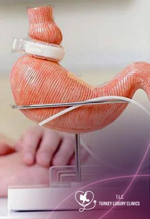 Lap Band vs Gastric Sleeve: Which Weight Loss Surgery Is Better?