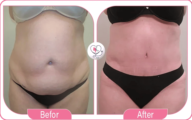 Stomach 360 lipo without tummy tuck before and after photos