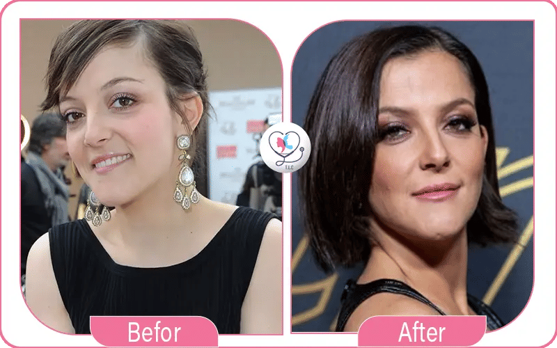 Camille Lellouche avant / après chirurgie