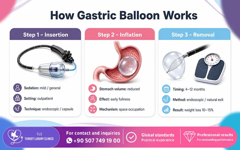 How Gastric Balloon Works