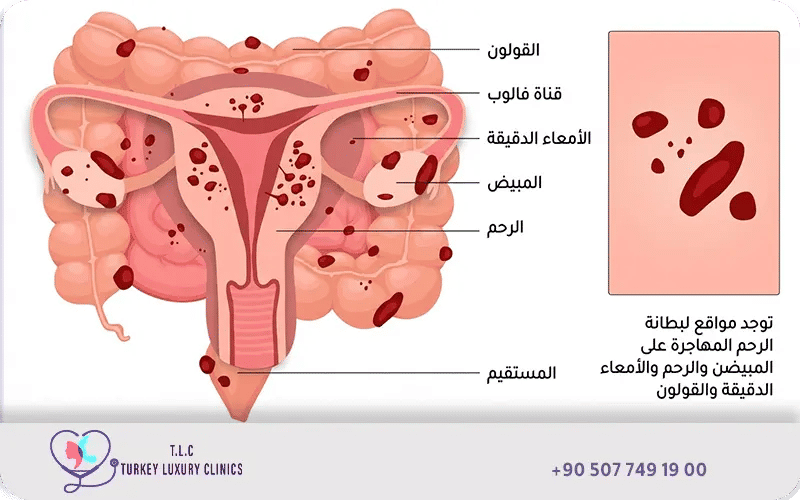 تكلفة عملية بطانة الرحم المهاجرة في مختلف الدول