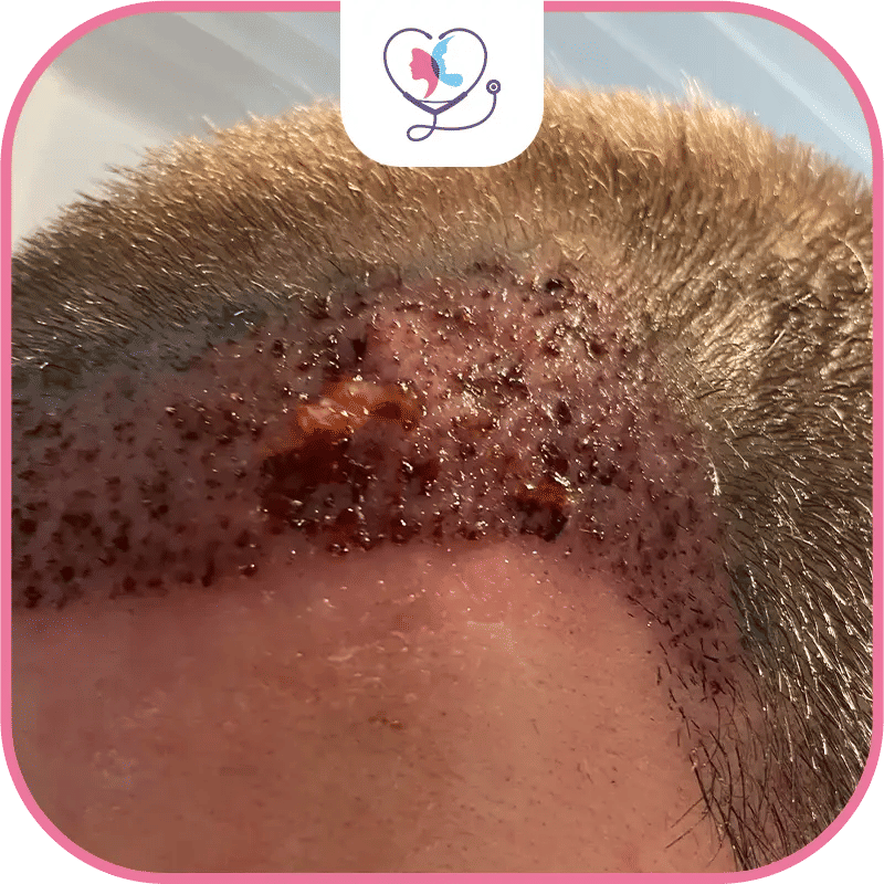 What are the symptoms of hair transplant infection?
