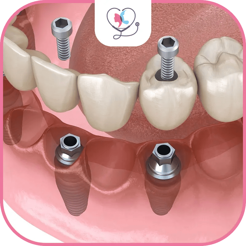 الفرق بين زراعة الأسنان all-on-6 وطقم الأسنان