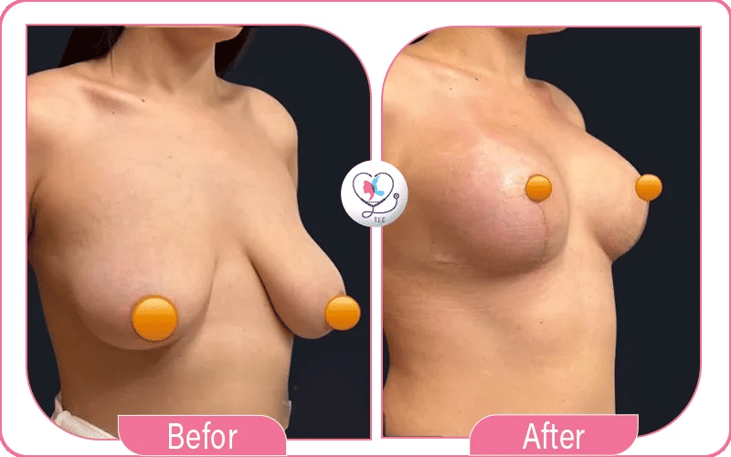 تجربتي مع سيليكون الثدي بالصور