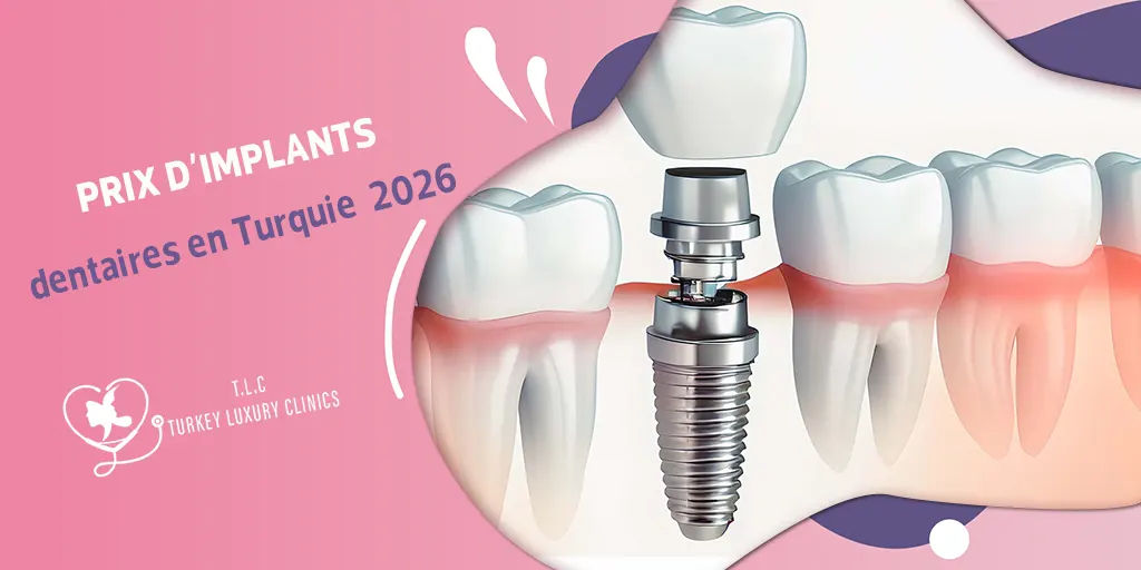 Prix d'Implants dentaires en Turquie 2026