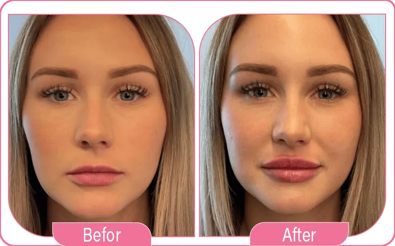 Lip Filler Before and After Results