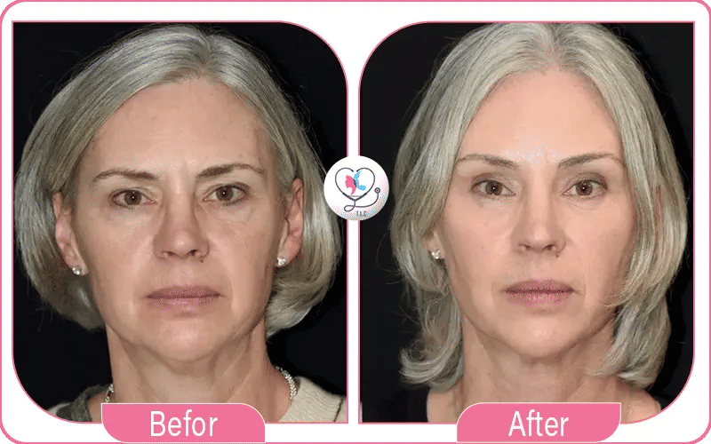 تجربتي مع رفع الحواجب بالخيوط