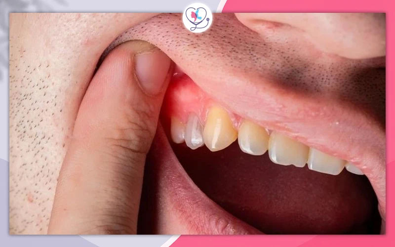 علاج اللثة والالتهابات