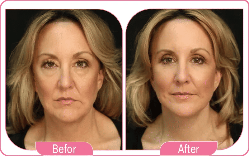 Non Surgical Facelift Results