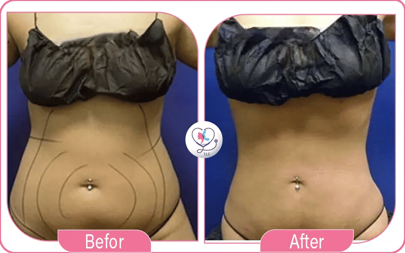 تكلفة شفط الدهون في مختلف الدول: دراسة مقارنة-1772048967726