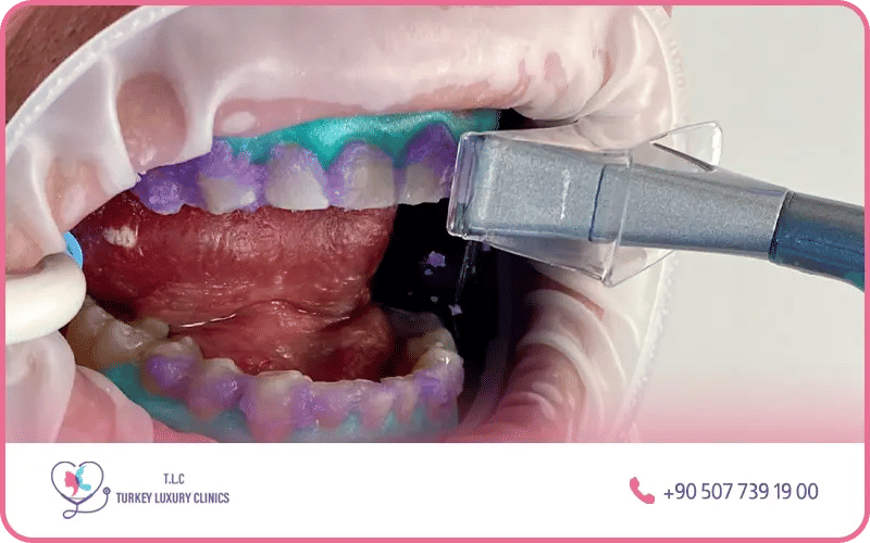 Le blanchiment dentaire au laser Le blanchiment dentaire au laser