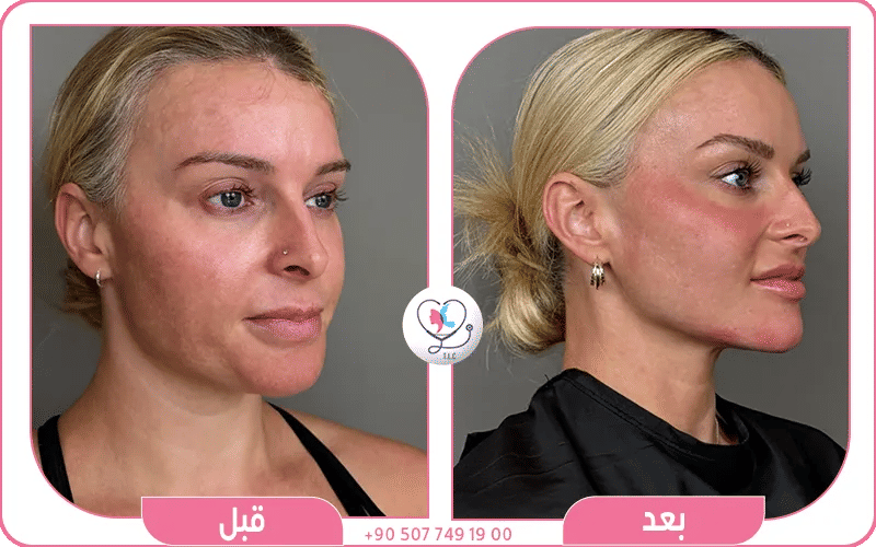 فيلر الذقن قبل وبعد