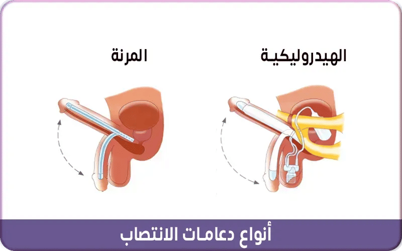 أنواع دعامات الانتصاب