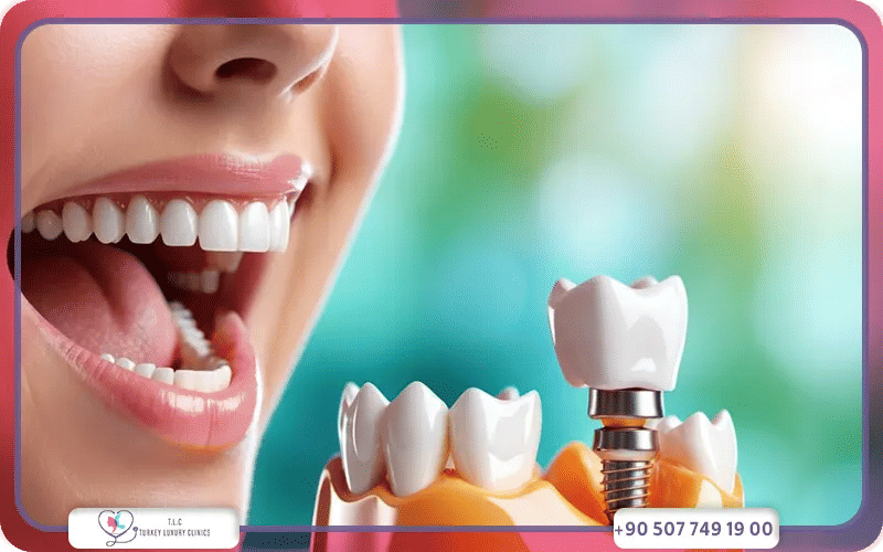 مميزات زرع الأسنان بعد الخلع مباشرة