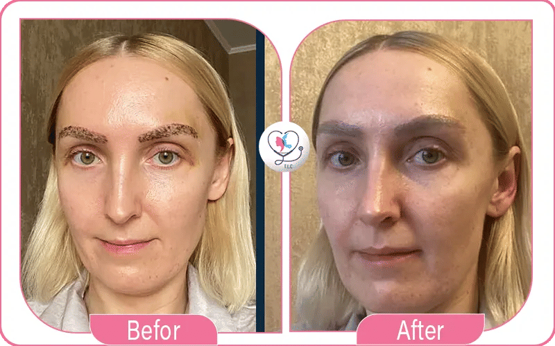 Why Choose Turkey for Eyebrow Transplants