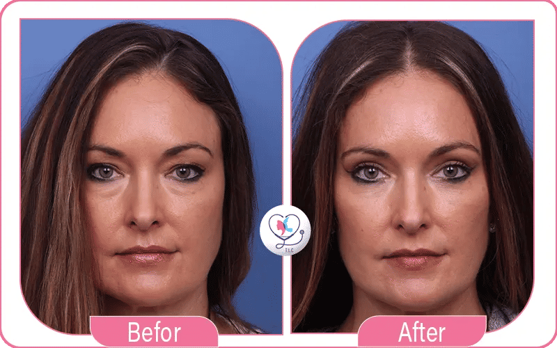 Risques et contre-indications de la blépharoplastie