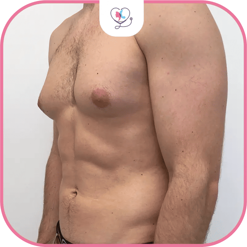 التثدي عند الرجال