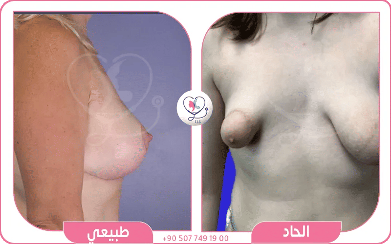 الثدي الحاد (Tuberous Breast)