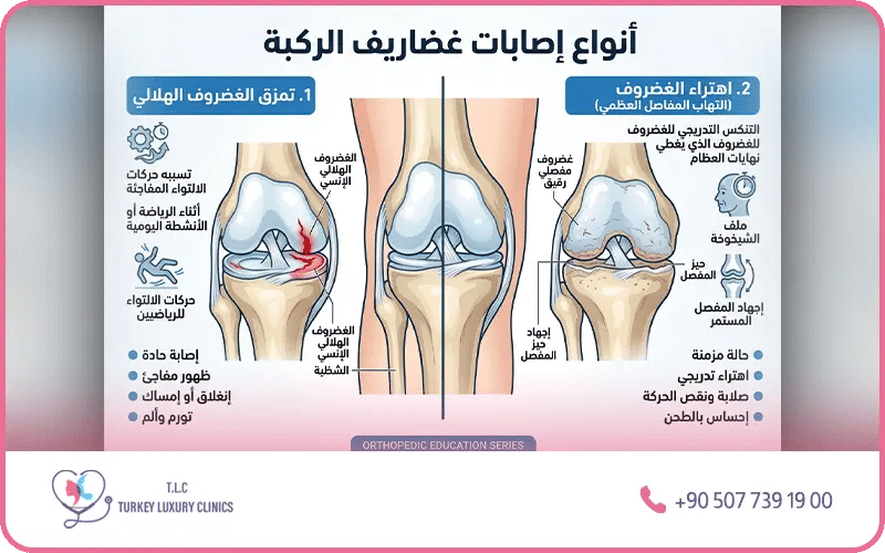 ما هي أنواع إصابات غضروف الركبة؟