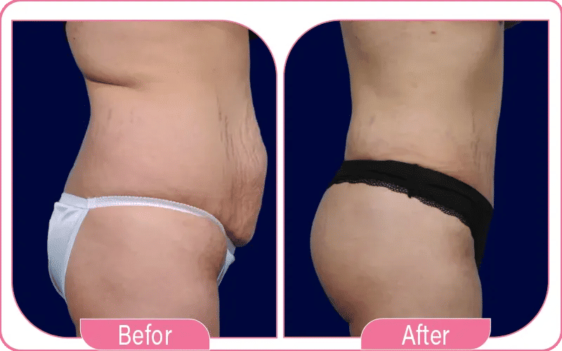 Résultats et cicatrices