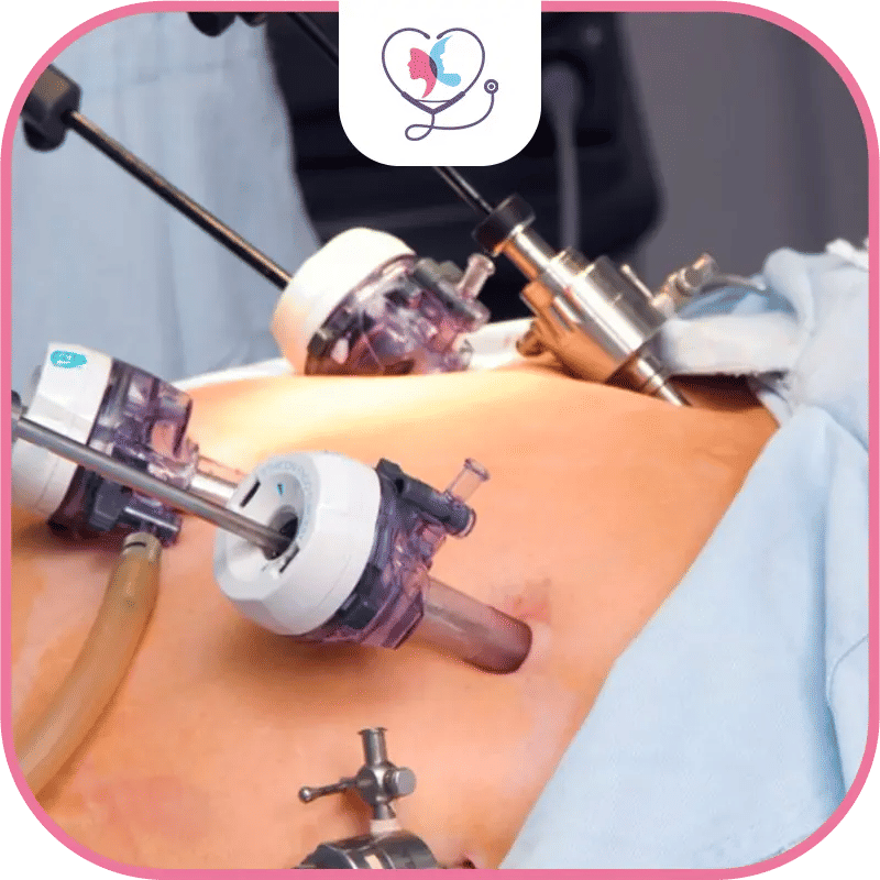 ما هي عوامل نجاح عملية تكميم المعدة؟