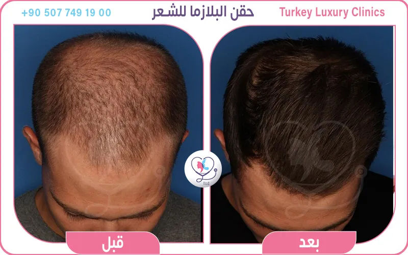 حقن البلازما للشعر قبل وبعد