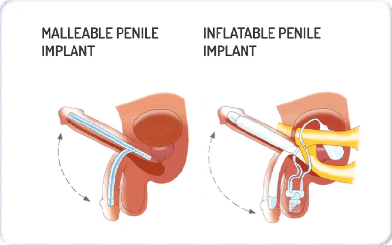 Types of Penile Implants (Inflatable vs Malleable)