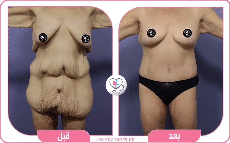 ما هي أسباب ترهل البطن