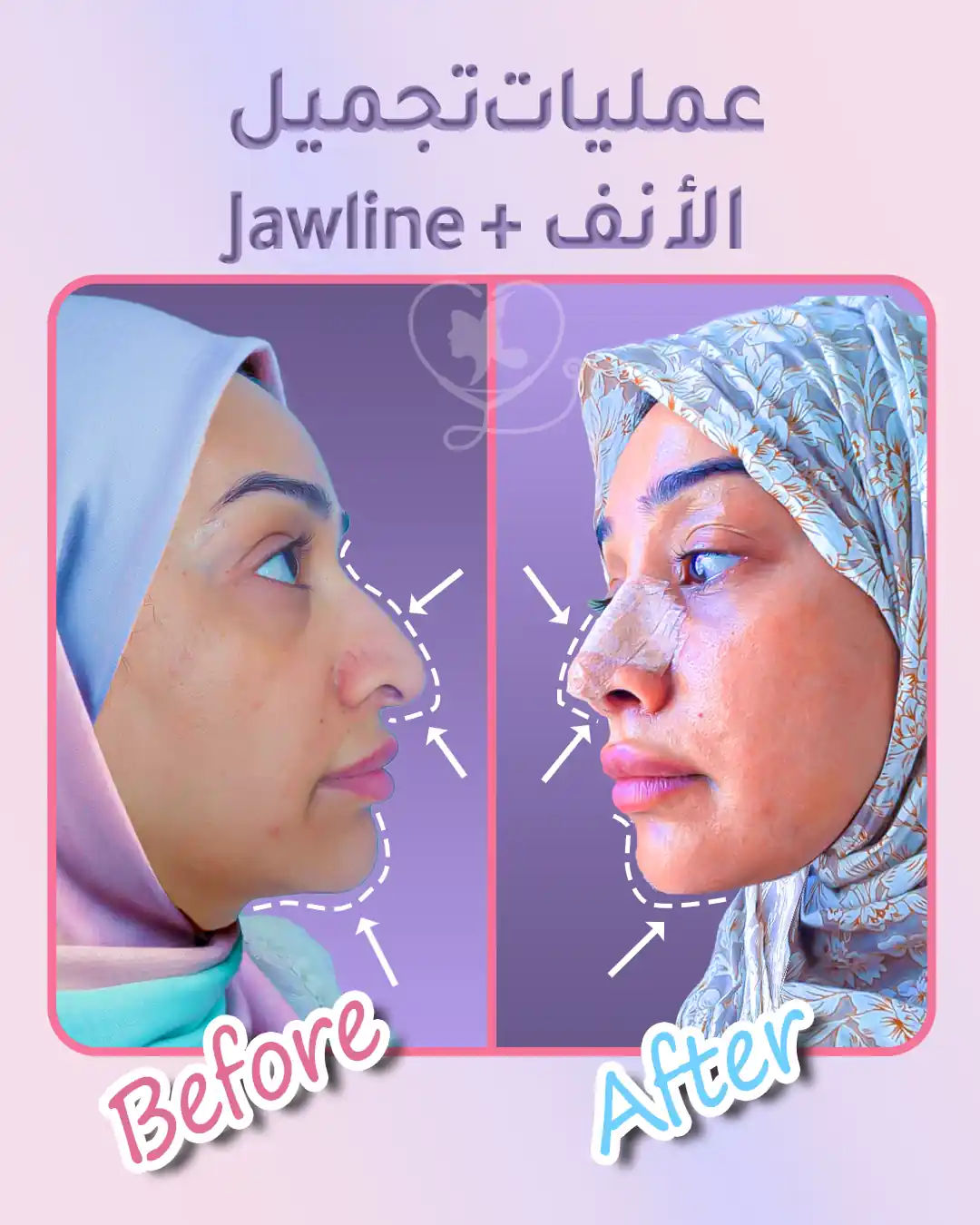 الأيام الأولى بعد عملية تجميل الأنف في الصورة