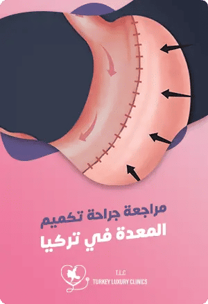 جراحة تصحيح تكميم المعدةfeatured image