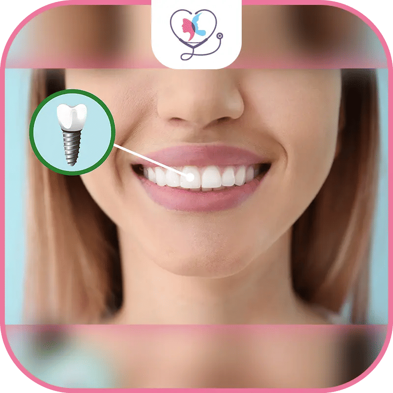 مراحل زراعة الاسنان