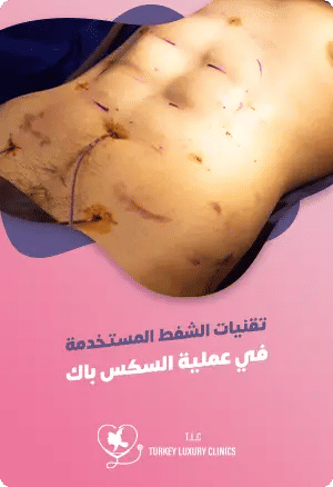 ما هي تقنيات الشفط المستخدمة في عملية Six-Pack؟featured image