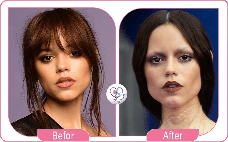 jenna ortega avant apres chirurgie esthétique-2