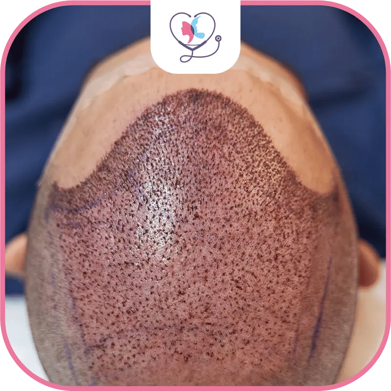 Advantages of FUE Hair Transplant Procedure