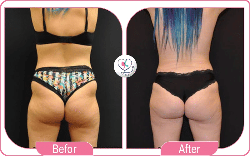Lipofilling fessier avant / après-6