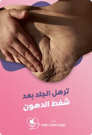 ترهل الجلد بعد شفط الدهونfeatured image