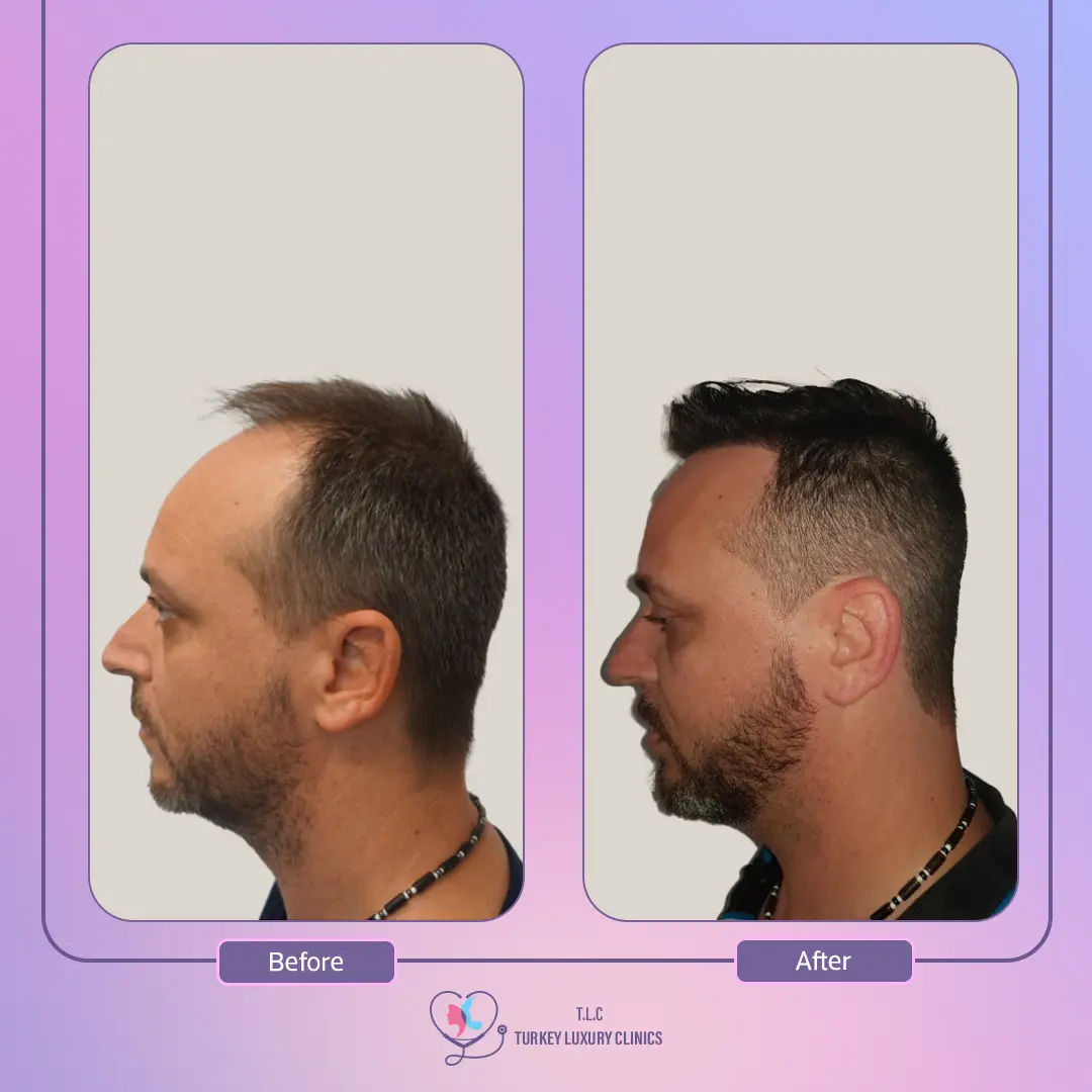 ماهي زراعة الشعر DHI في تركيا؟