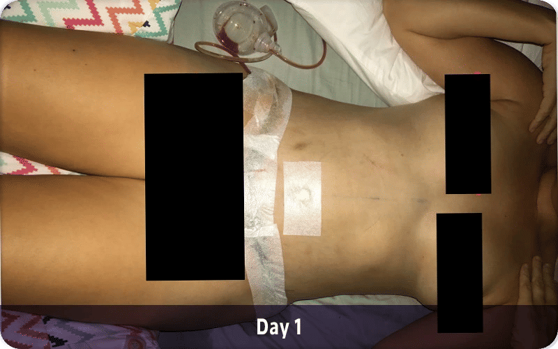 Tummy Tuck Recovery Period Week by Week