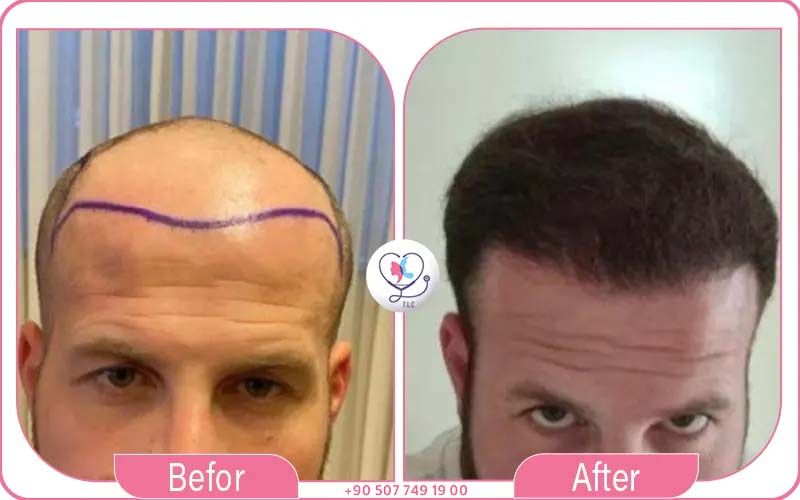 Before and after hair transplant comparison showing restored hairline and improved hair density at Turkey Luxury Clinics