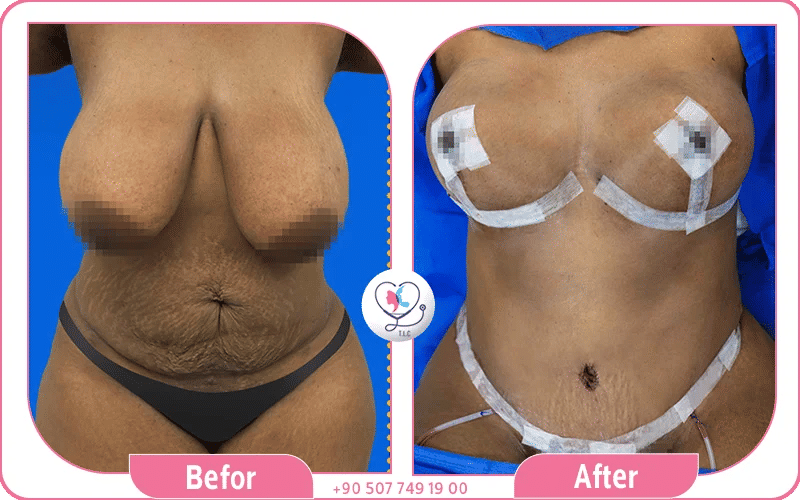 Mommy Makeover full body contouring by tummy tuck and liposuction for lifted breast, tightening tummy.