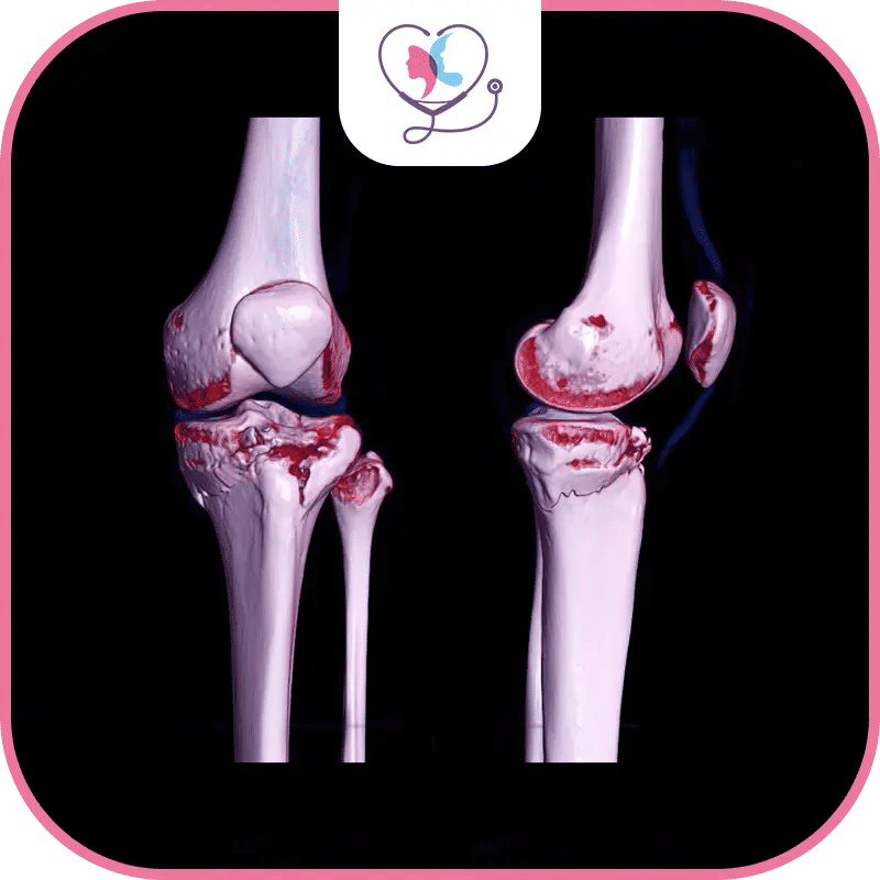 مراجعة استبدال مفصل الركبة